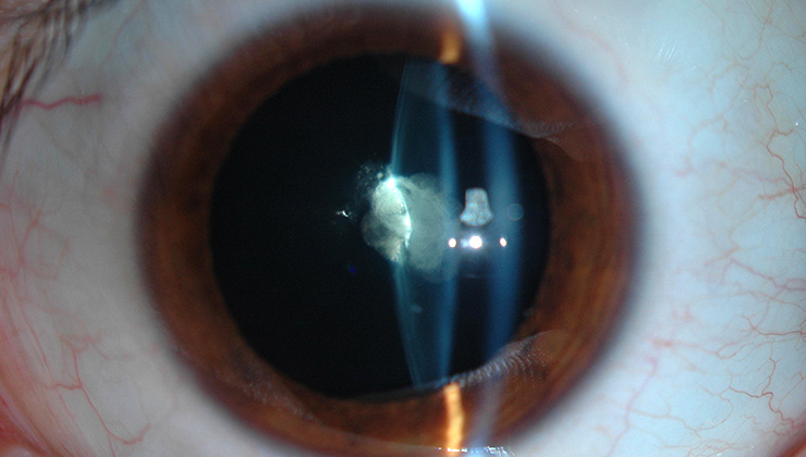 congenital cataract