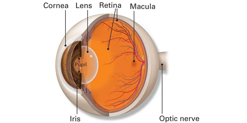 cataract