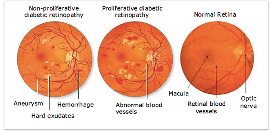 congenital cataract